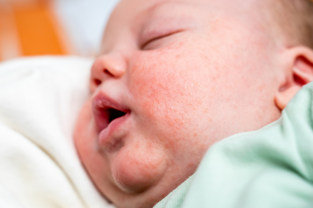 Navigating Milk Allergies in Babies